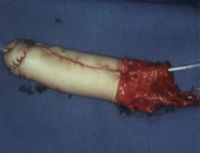 Priporaty penis enlargement