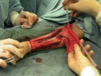Phalloplasty vs clitoris Black dick free movie sex slut white